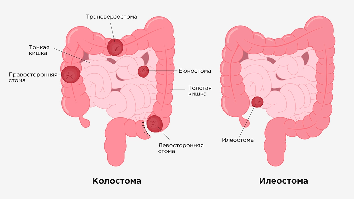 После резекции кишечника нет стула